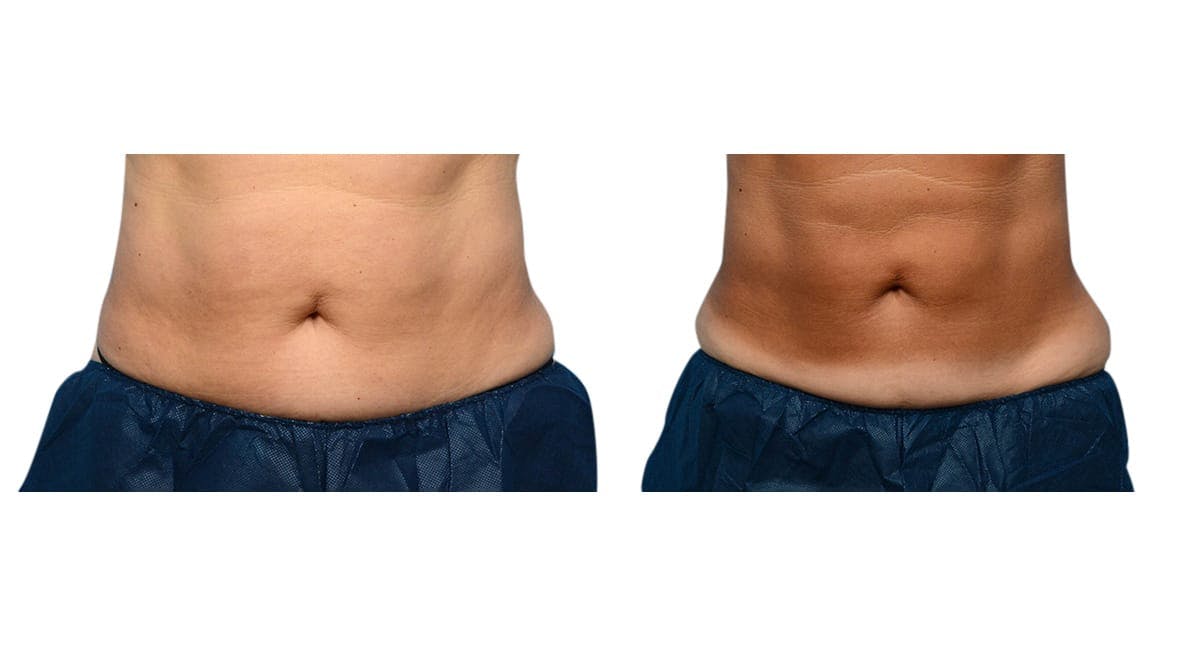 CoolSculpting® Before & After Gallery - Patient 332616 - Image 1