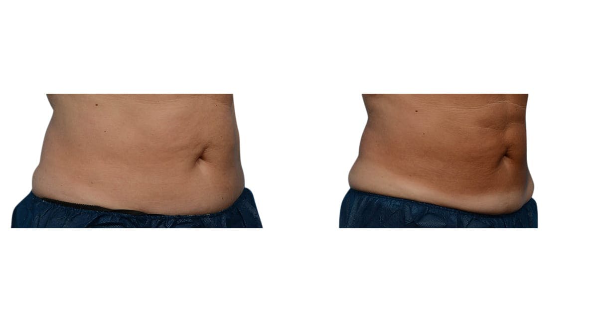 CoolSculpting® Before & After Gallery - Patient 332616 - Image 2