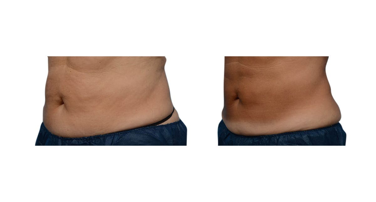 CoolSculpting® Before & After Gallery - Patient 332616 - Image 3