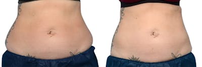 CoolSculpting® Before & After Gallery - Patient 216555 - Image 1
