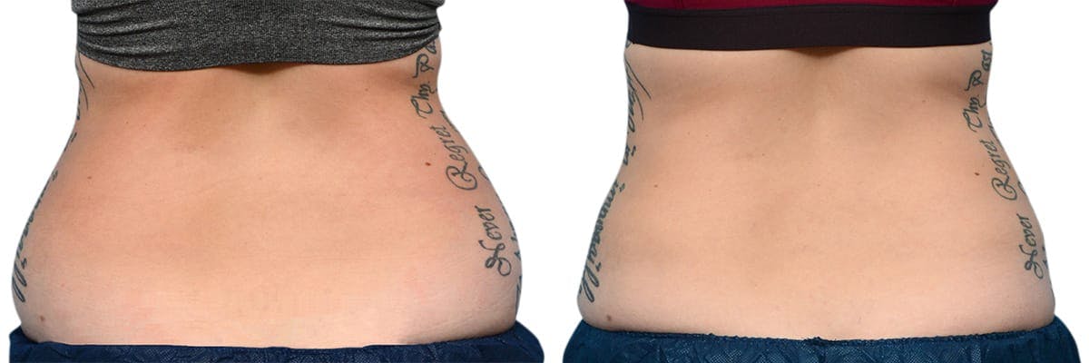 CoolSculpting® Before & After Gallery - Patient 216555 - Image 2
