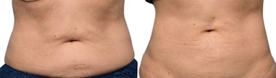 CoolSculpting® Before & After Gallery - Patient 352469 - Image 1