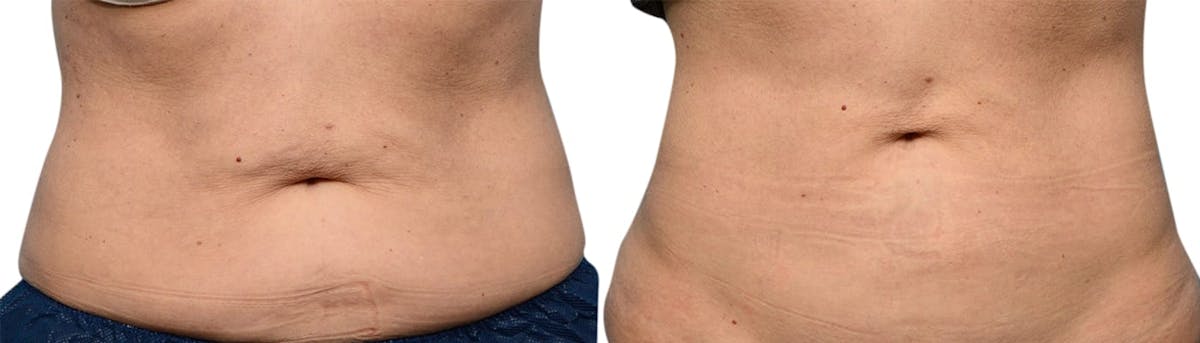 CoolSculpting® Before & After Gallery - Patient 352469 - Image 1