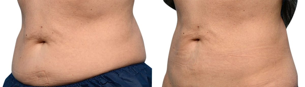 CoolSculpting® Before & After Gallery - Patient 352469 - Image 2
