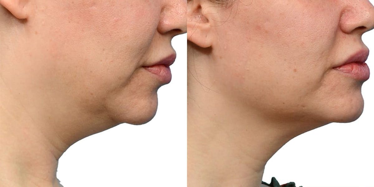 Ultherapy® Before & After Gallery - Patient 312573 - Image 2