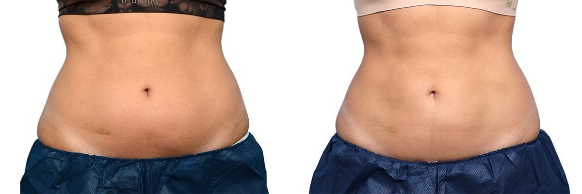 CoolSculpting® Before & After Gallery - Patient 160014 - Image 1