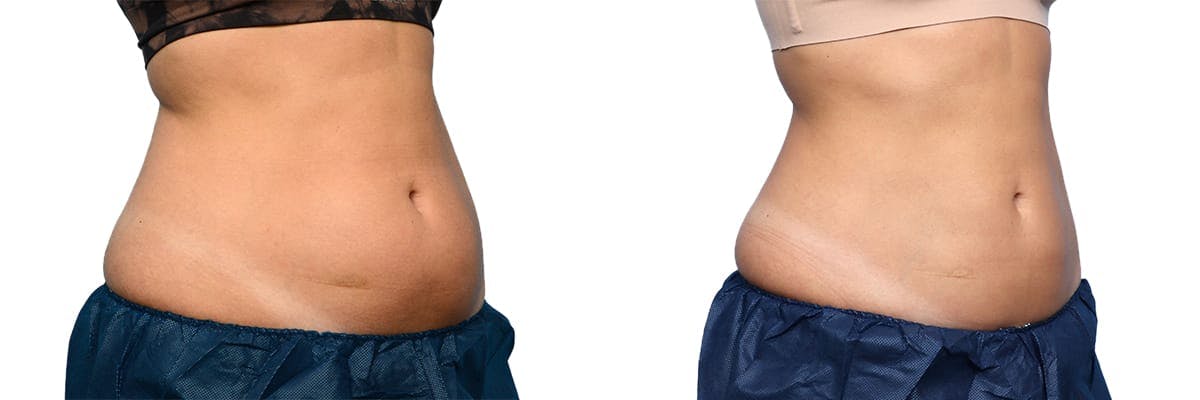 CoolSculpting® Before & After Gallery - Patient 160014 - Image 2