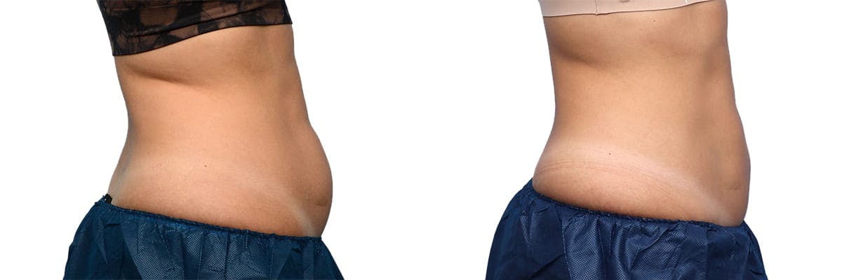 CoolSculpting® Before & After Gallery - Patient 160014 - Image 3