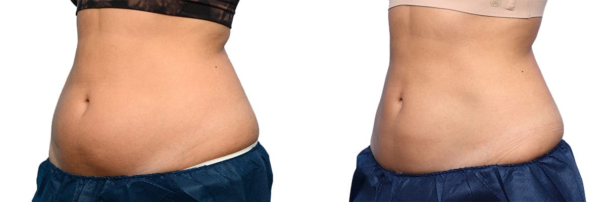 CoolSculpting® Before & After Gallery - Patient 160014 - Image 4