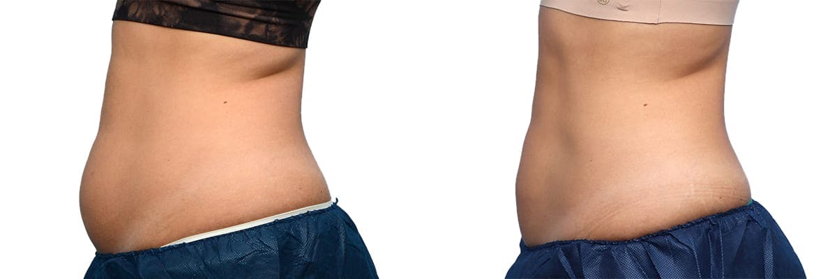 CoolSculpting® Before & After Gallery - Patient 160014 - Image 5