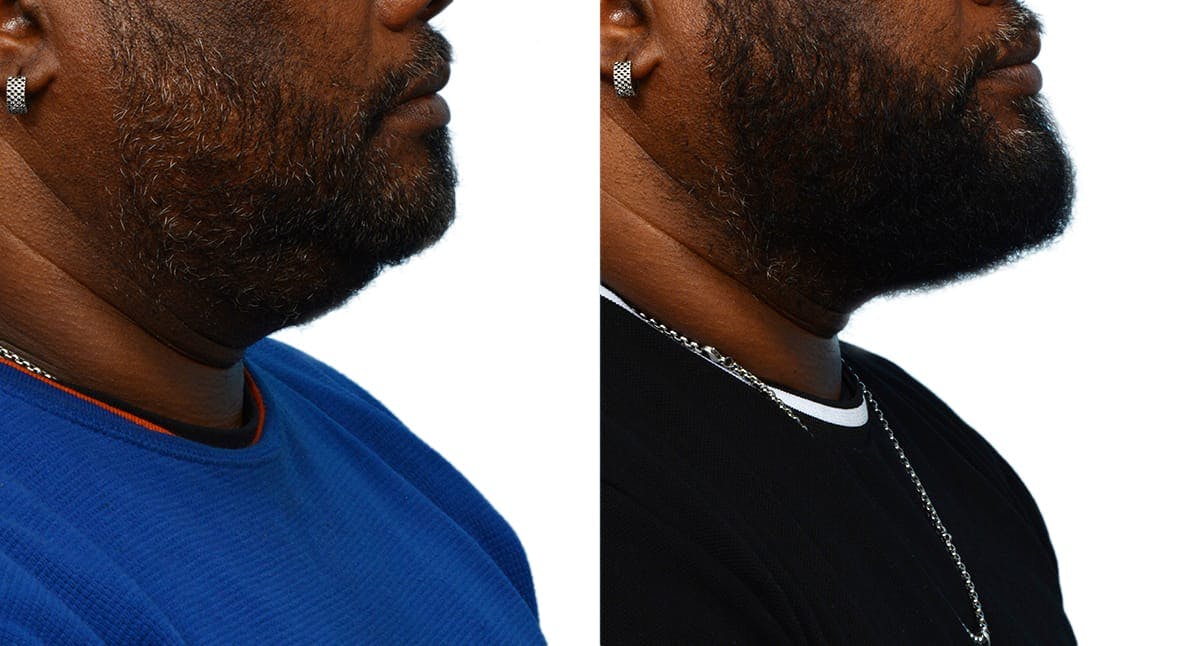Chin Augmentation Before & After Gallery - Patient 176797 - Image 1