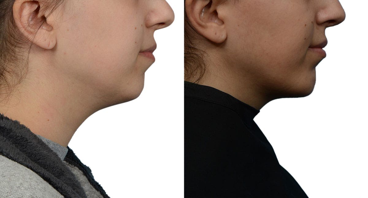 Chin Augmentation Before & After Gallery - Patient 135961 - Image 1