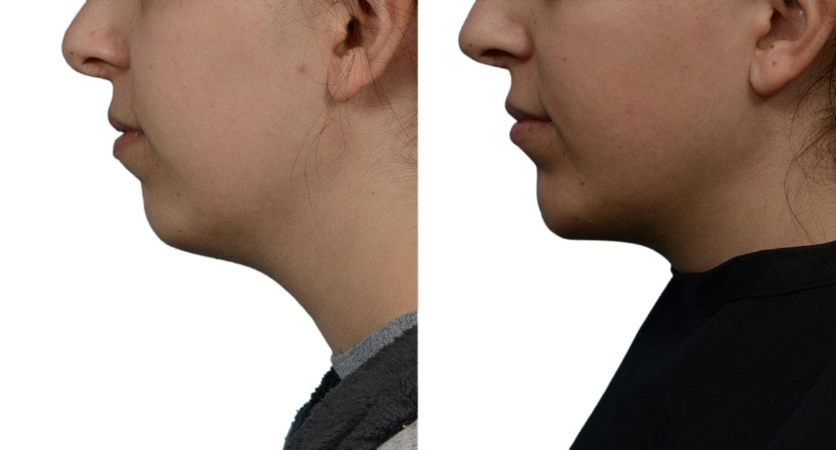 Chin Augmentation Before & After Gallery - Patient 135961 - Image 2