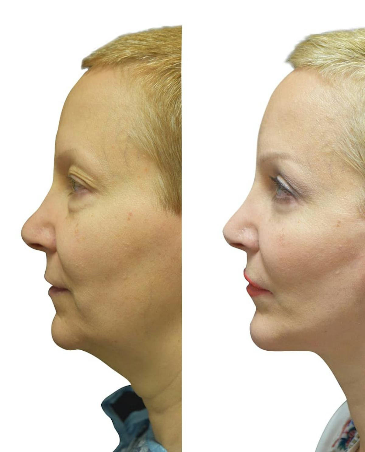 Chin Augmentation Before & After Gallery - Patient 246078 - Image 1