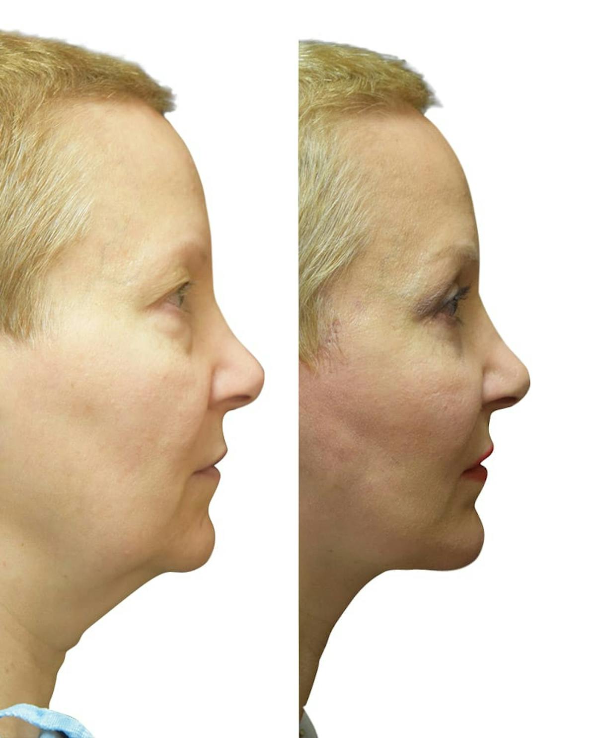 Chin Augmentation Before & After Gallery - Patient 246078 - Image 2