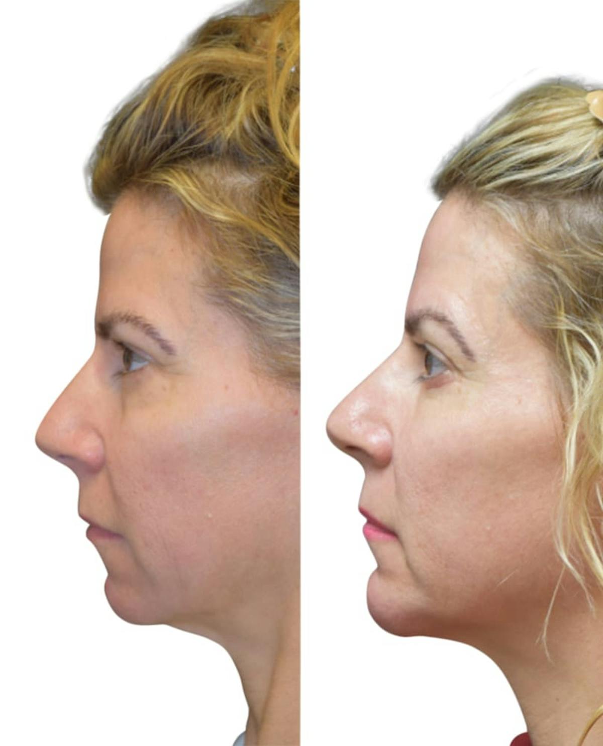 Chin Augmentation Before & After Gallery - Patient 163127 - Image 1