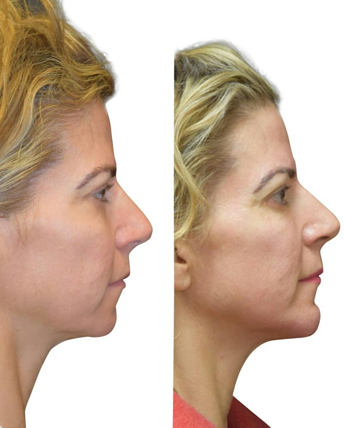 Chin Augmentation Before & After Gallery - Patient 163127 - Image 2