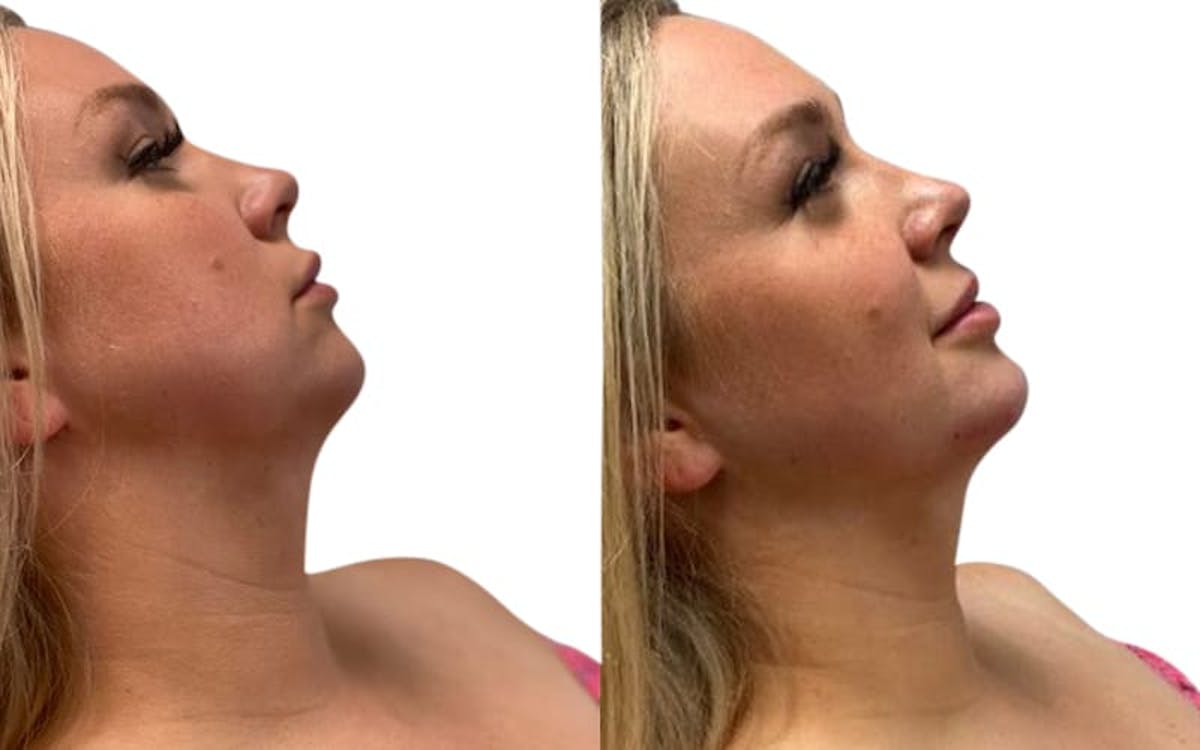 Chin Augmentation Before & After Gallery - Patient 384095 - Image 1