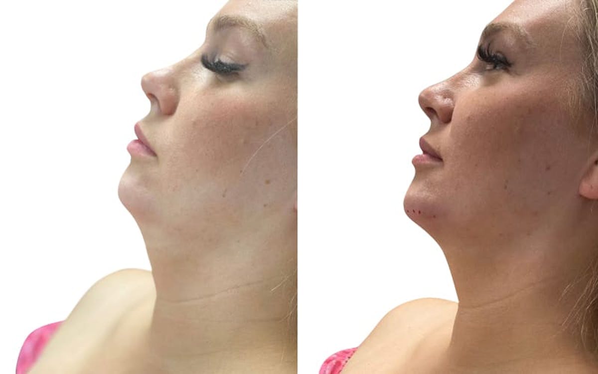 Chin Augmentation Before & After Gallery - Patient 384095 - Image 2