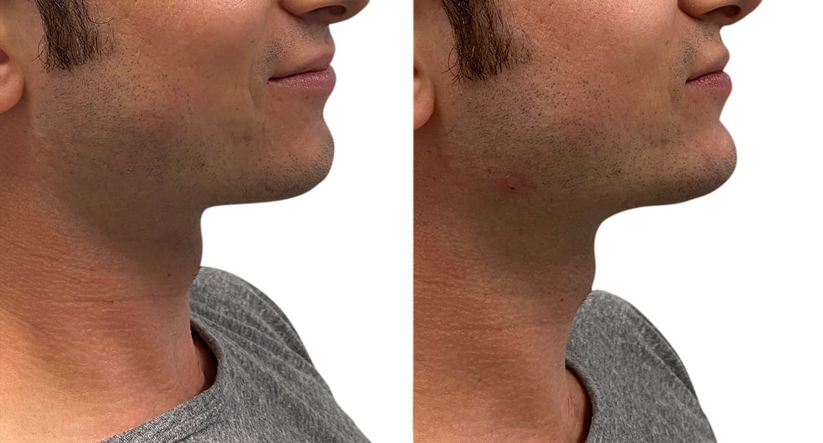 Chin Augmentation Before & After Gallery - Patient 278392 - Image 1