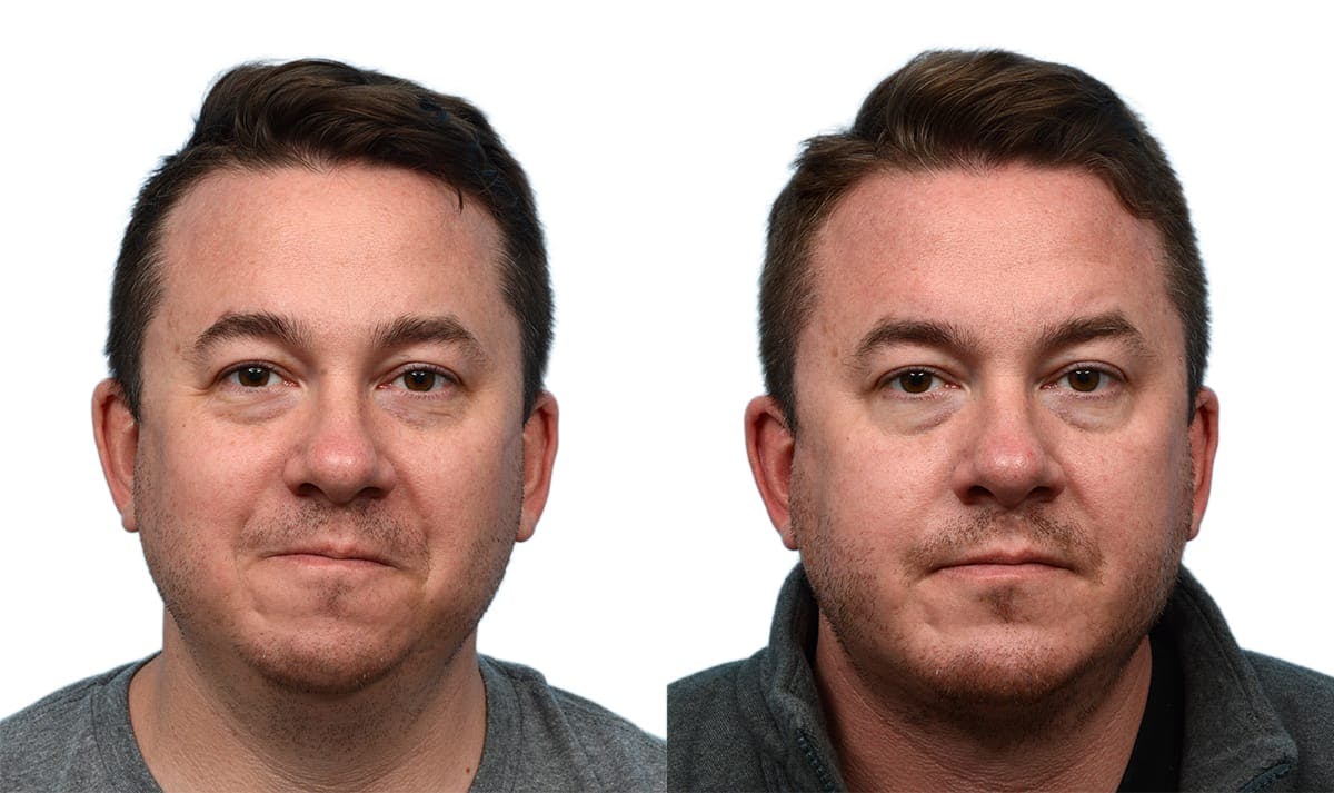 Chin Augmentation Before & After Gallery - Patient 268423 - Image 1