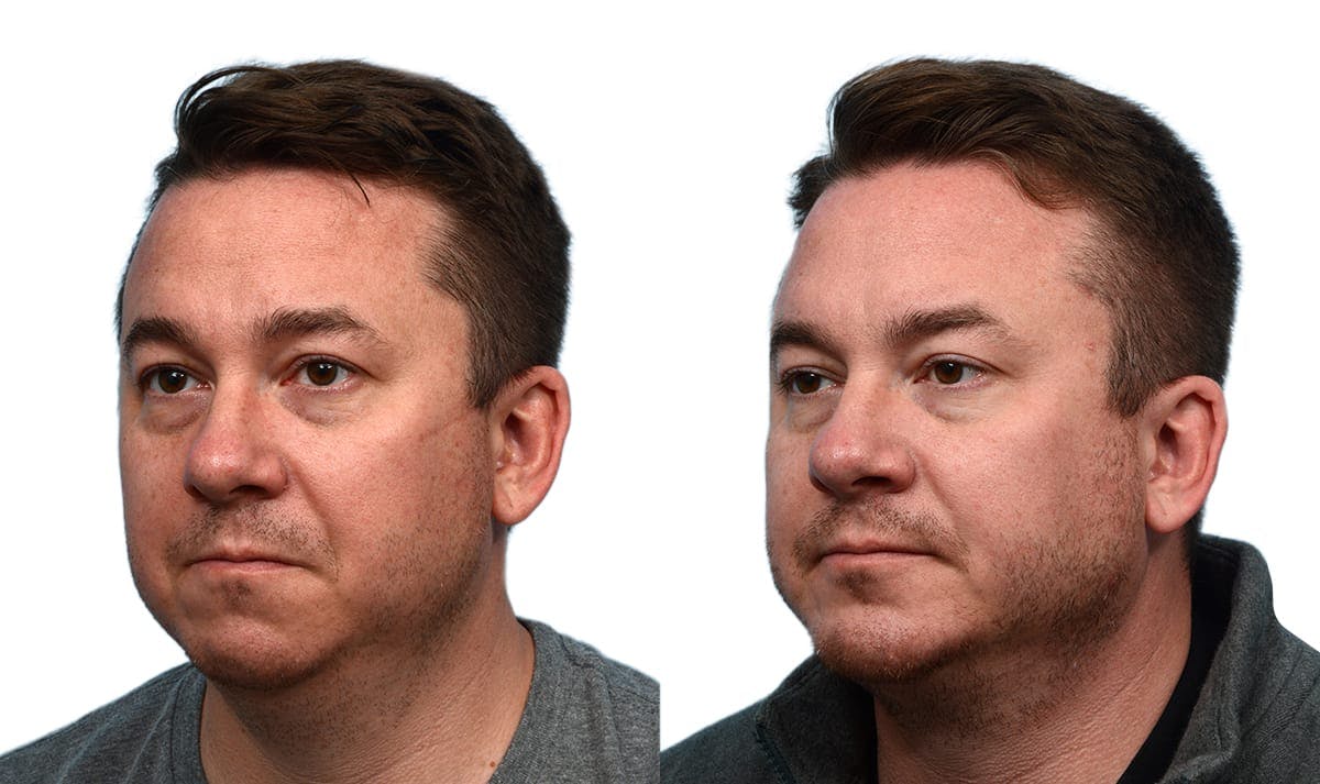 Chin Augmentation Before & After Gallery - Patient 268423 - Image 2