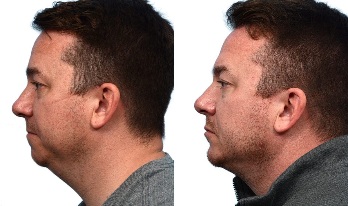 Chin Augmentation Before & After Gallery - Patient 268423 - Image 3