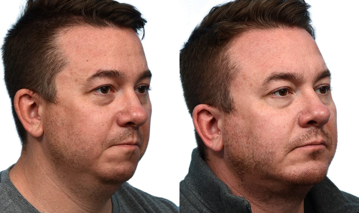 Chin Augmentation Before & After Gallery - Patient 268423 - Image 4