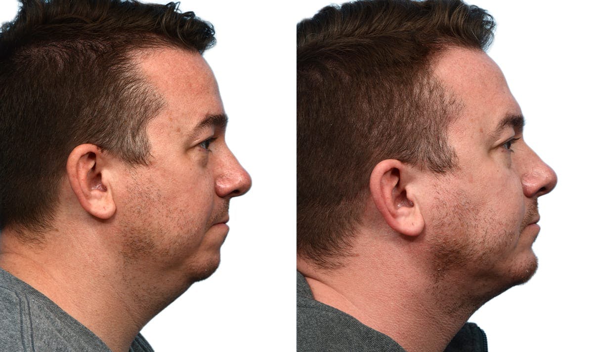Chin Augmentation Before & After Gallery - Patient 268423 - Image 5