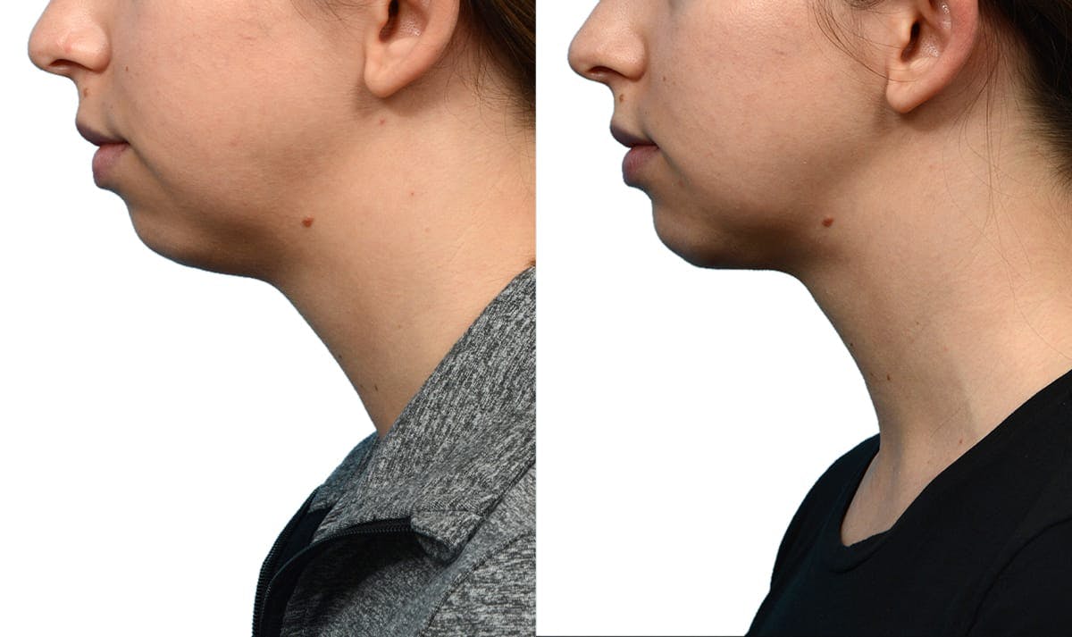 Chin Augmentation Before & After Gallery - Patient 235996 - Image 1
