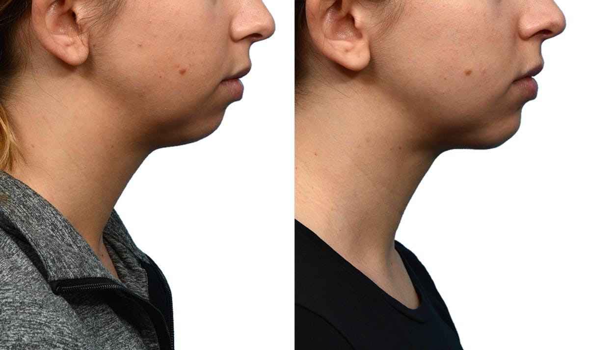 Chin Augmentation Before & After Gallery - Patient 235996 - Image 2