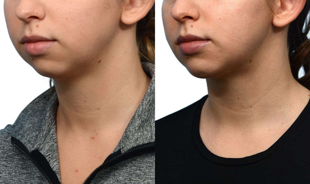 Chin Augmentation Before & After Gallery - Patient 235996 - Image 3