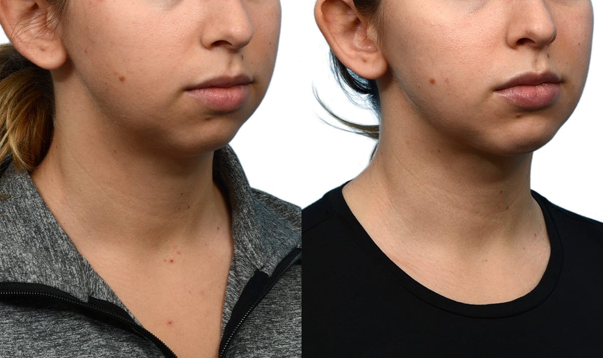 Chin Augmentation Before & After Gallery - Patient 235996 - Image 4