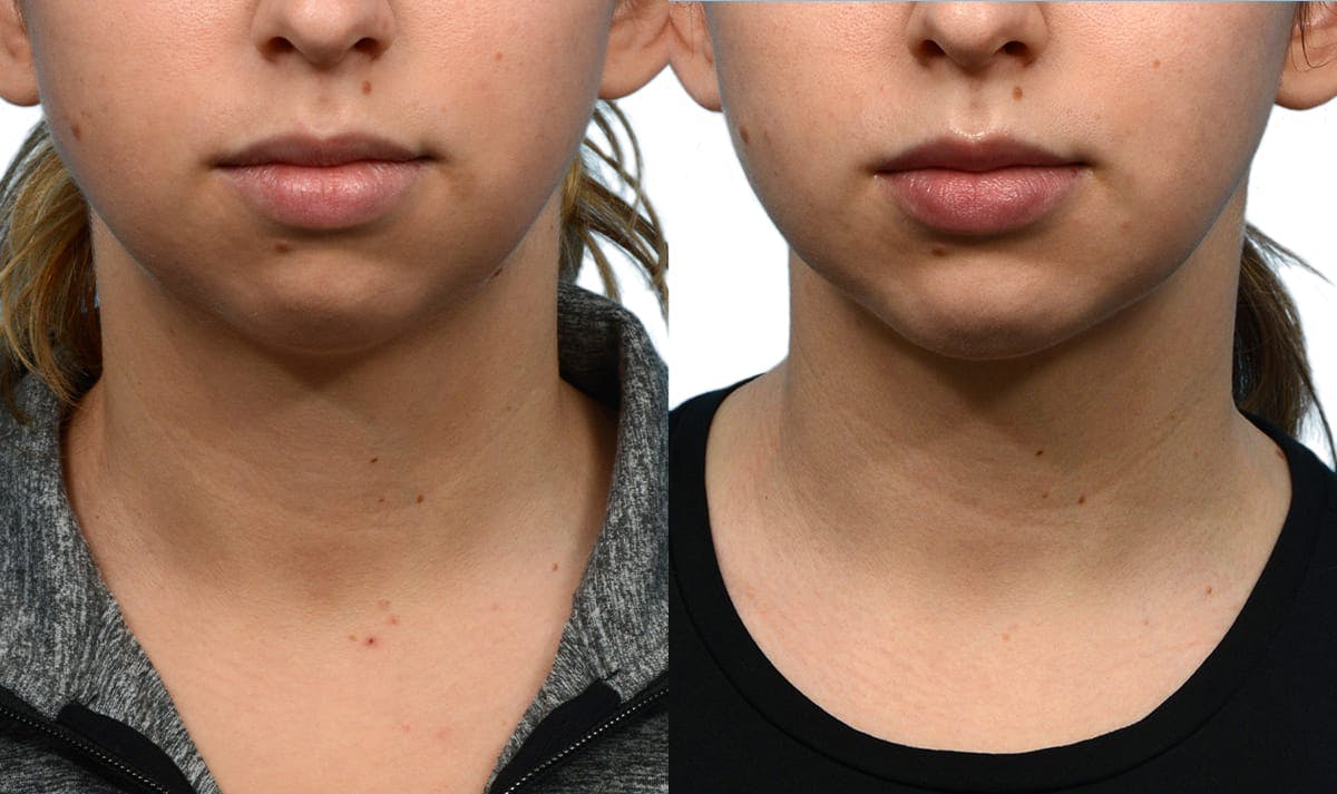 Chin Augmentation Before & After Gallery - Patient 235996 - Image 5