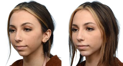 Chin Augmentation Before & After Gallery - Patient 422780 - Image 1