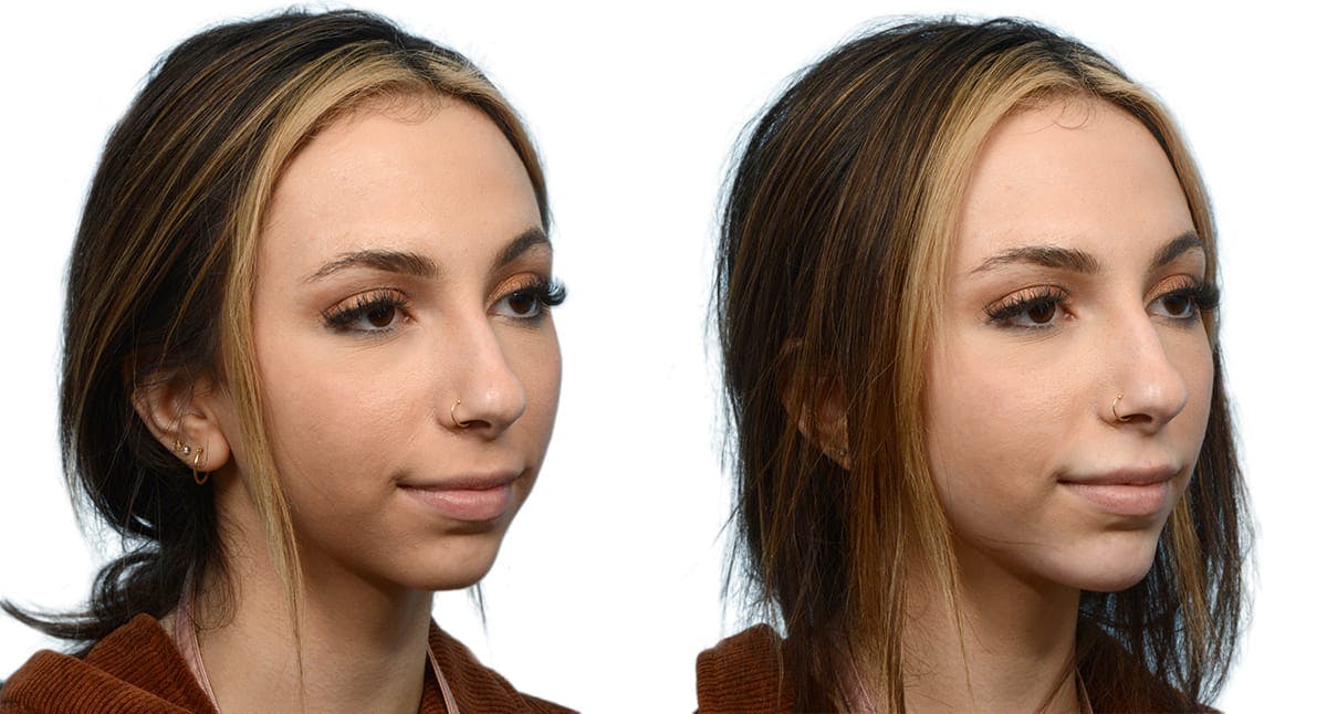 Chin Augmentation Before & After Gallery - Patient 422780 - Image 2
