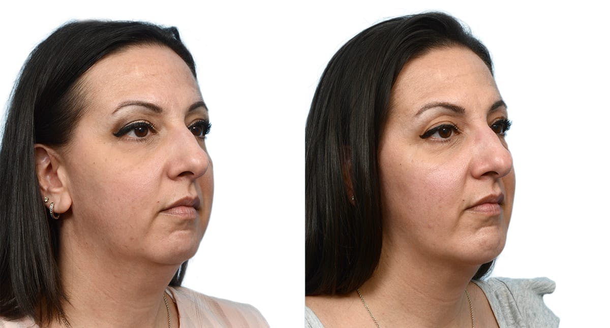 Chin Augmentation Before & After Gallery - Patient 309937 - Image 1