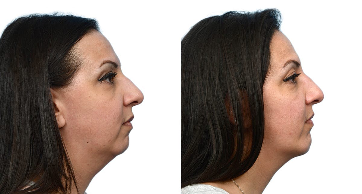 Chin Augmentation Before & After Gallery - Patient 309937 - Image 2