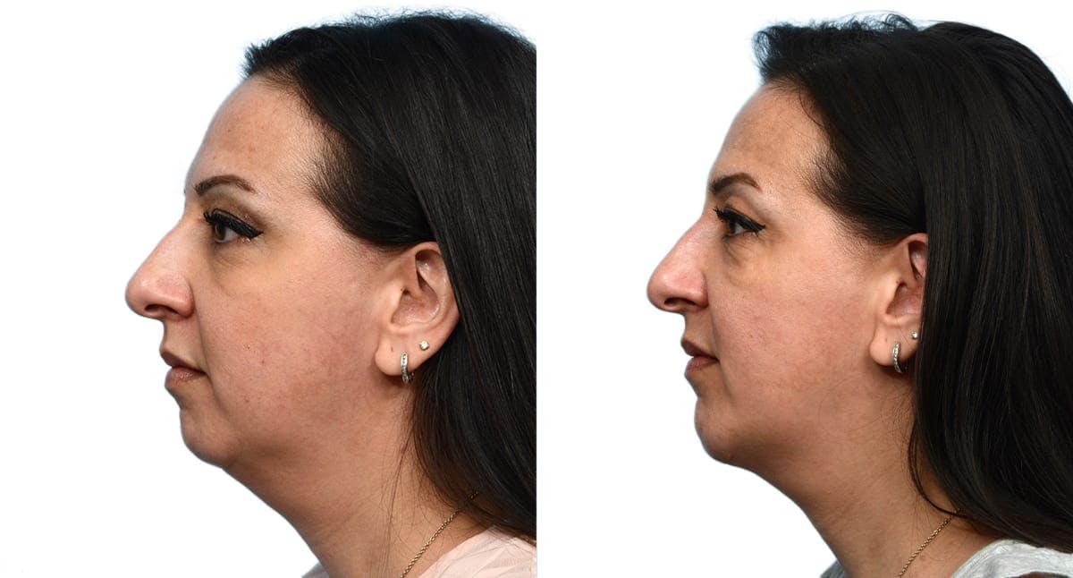 Chin Augmentation Before & After Gallery - Patient 309937 - Image 3