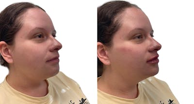 Chin Augmentation Before & After Gallery - Patient 272227 - Image 1