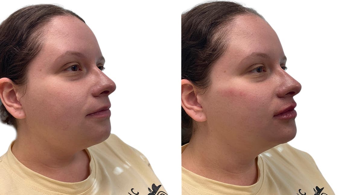 Chin Augmentation Before & After Gallery - Patient 332870 - Image 1