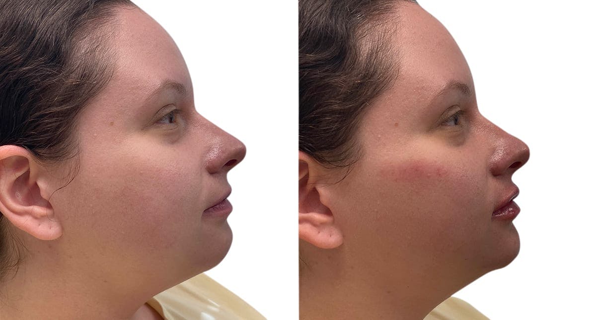Chin Augmentation Before & After Gallery - Patient 332870 - Image 2