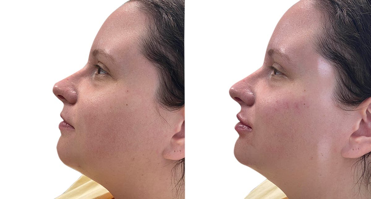 Chin Augmentation Before & After Gallery - Patient 332870 - Image 3