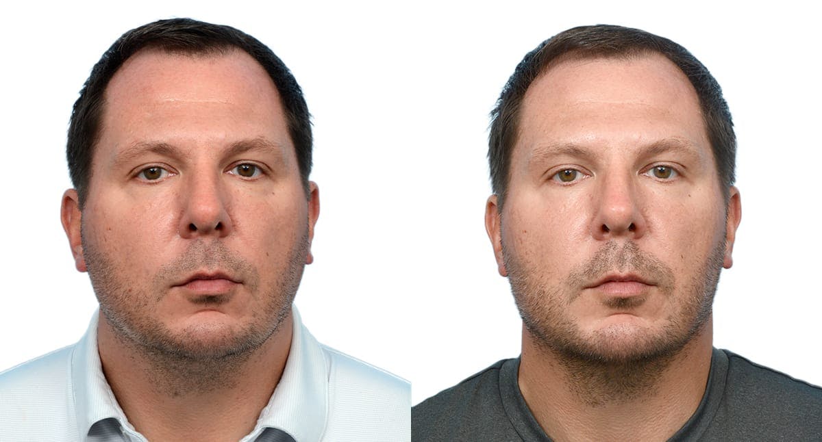 Chin Augmentation Before & After Gallery - Patient 281452 - Image 1