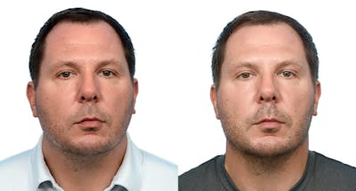 Chin Augmentation Before & After Gallery - Patient 410048 - Image 1