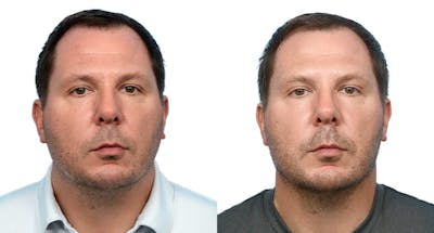 Chin Augmentation Before & After Gallery - Patient 281452 - Image 1