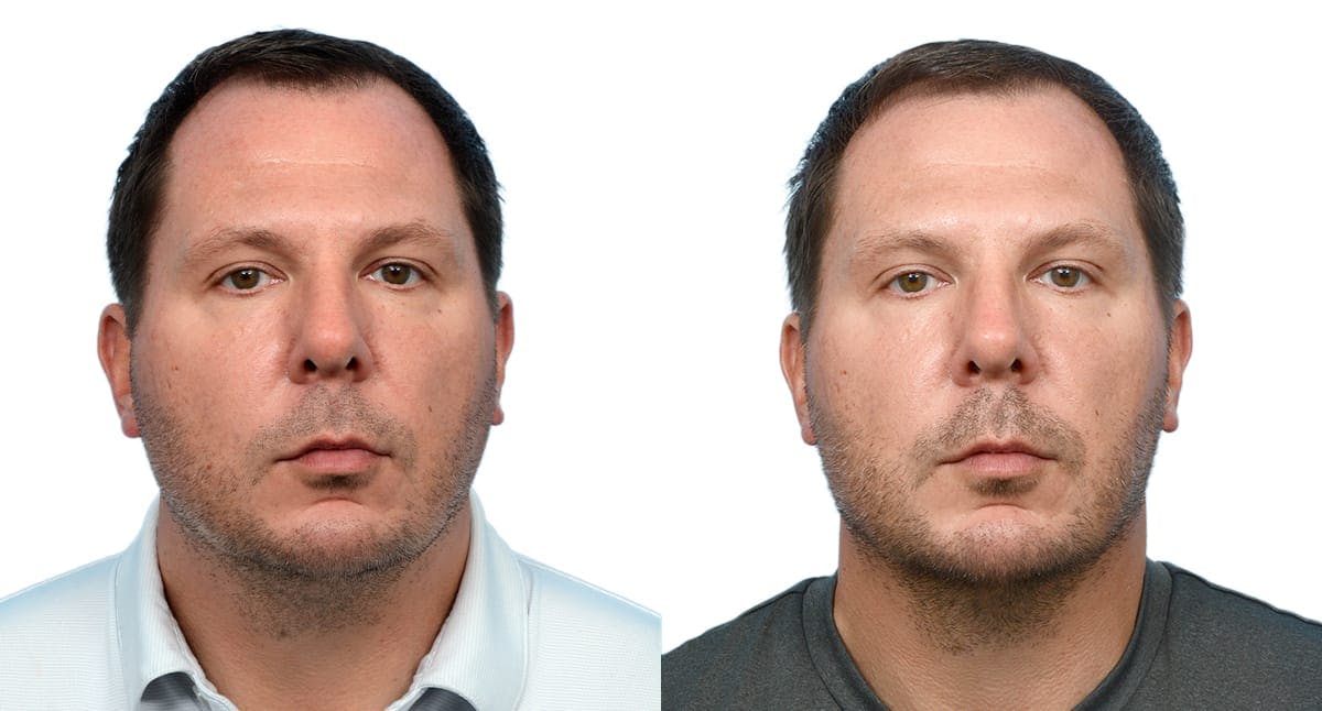 Chin Augmentation Before & After Gallery - Patient 410048 - Image 1