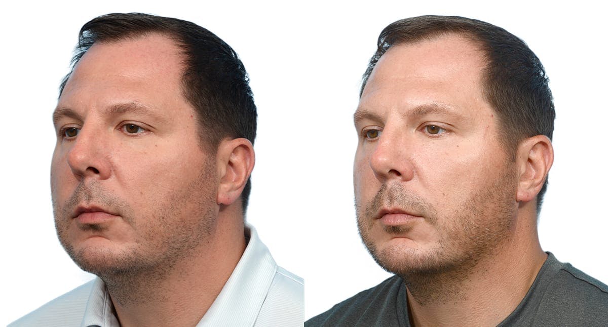 Chin Augmentation Before & After Gallery - Patient 410048 - Image 2