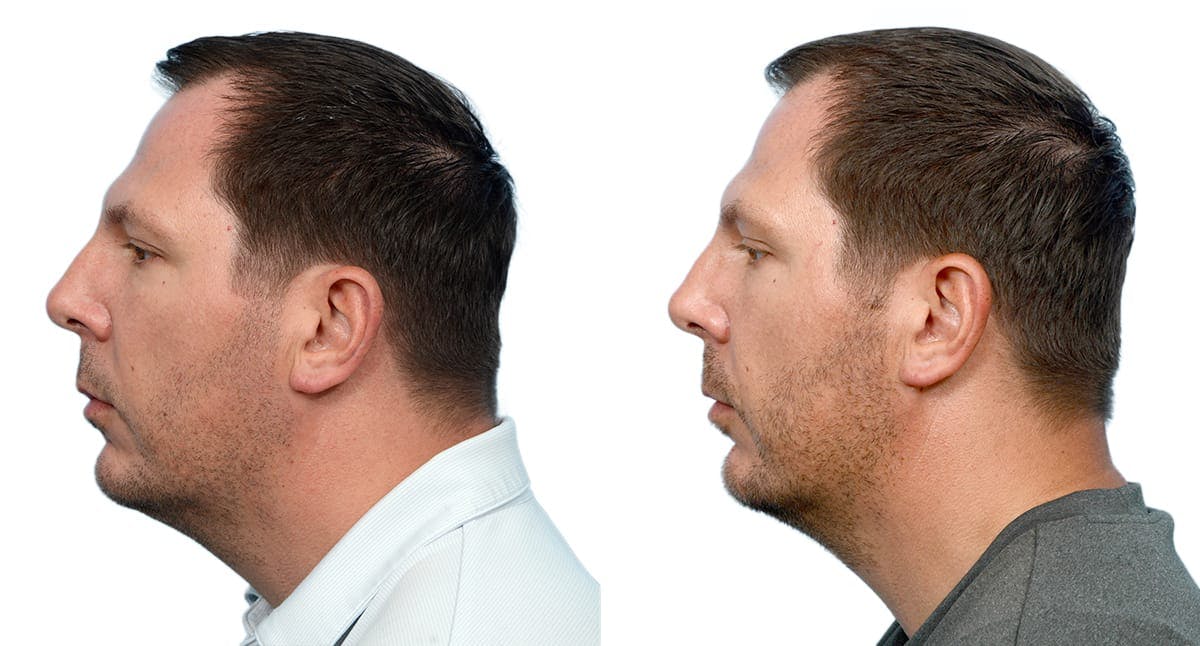 Chin Augmentation Before & After Gallery - Patient 410048 - Image 3