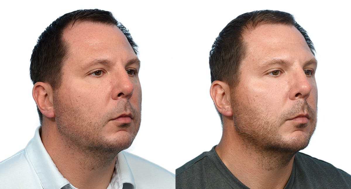 Chin Augmentation Before & After Gallery - Patient 281452 - Image 4